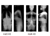 71세 여자 환자로 수술전 방사선 사진에서 심한 척추 측만증 및 척추 후만증을 보이고 있다. 제1요추에서 제1천추까지 후방 유합술 및 장골나사를 이용하여 장골 고정술 시행 후 수술 전의 측만증 및 후만증이 잘 교정되고 척추의 균형이 잘 유지된 소견을 보여주고 있다.