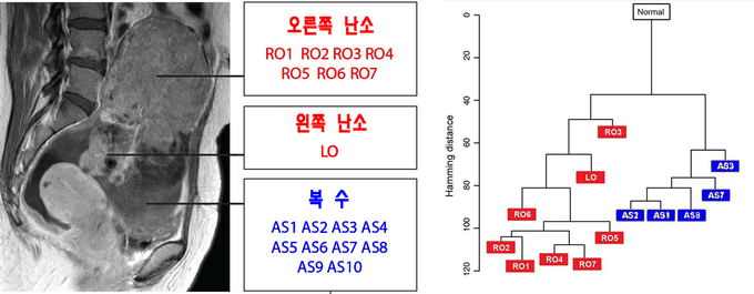 연구팀은 좌우 난소와 전이된 복수에서 암조직을 17개(사진 왼쪽)를 채취해 계통수를 제작했다(사진 오른쪽). 연구 결과 원발 부위 암세포와 전이가 된 복수 세포의 유전자 변이는 다른 계통으로 분류됐다.