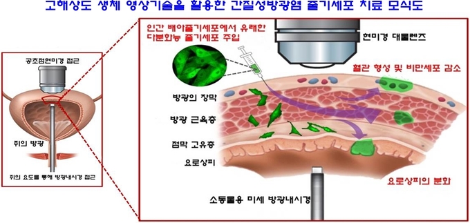 고해상도 생체 영상기술을 활용한 간질성방광염 줄기세포 치료 모식도 ....쥐의 방광에 인간 배아줄기세포 유래 다분화능 줄기세포를 주입한 후 미세현미경과 방광내시경으로 관찰한 결과, 혈관 형성과 비만세포의 감소, 배아줄기세포가 살아있는 세포로 분화된 것을 확인할 수 있었다.