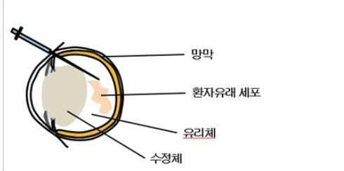 난치성 뇌암 안구내 주사 동물모델 모식도