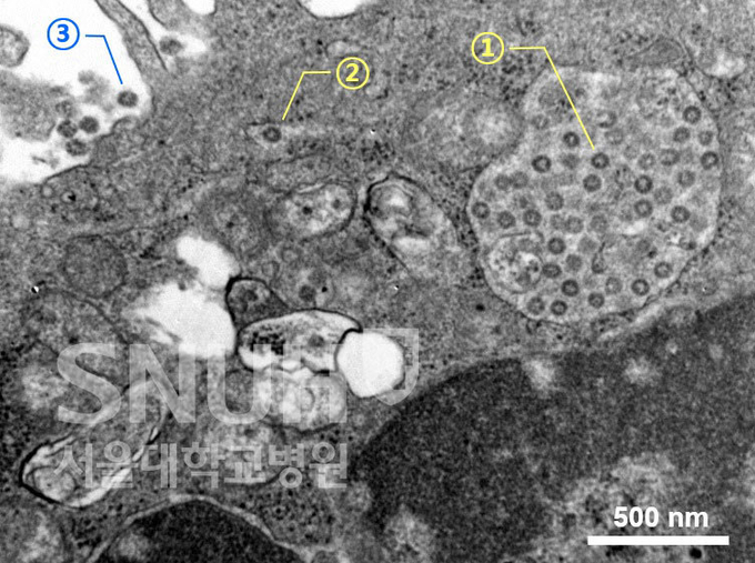 신종 코로나바이러스에 감염된 세포(Vero cell)의 전자현미경 사진으로 신종 코로나바이러스의 생활사를 보여준다. ① 세포 내에 가득 모여 있는 바이러스 입자, ② 세포 밖으로 이동 중인 바이러스 입자, ③ 세포 밖으로 터져 나온 바이러스 입자