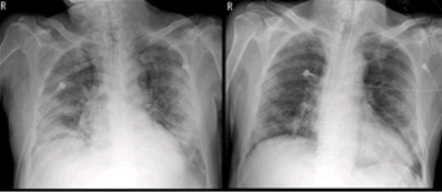김모씨가 혈장치료를 받기 전(좌)과 후(우)의 흉부 X-ray 영상. 혈장치료 후 폐렴 등으로 뿌옇게 보이던 폐가 나아지고 있다.