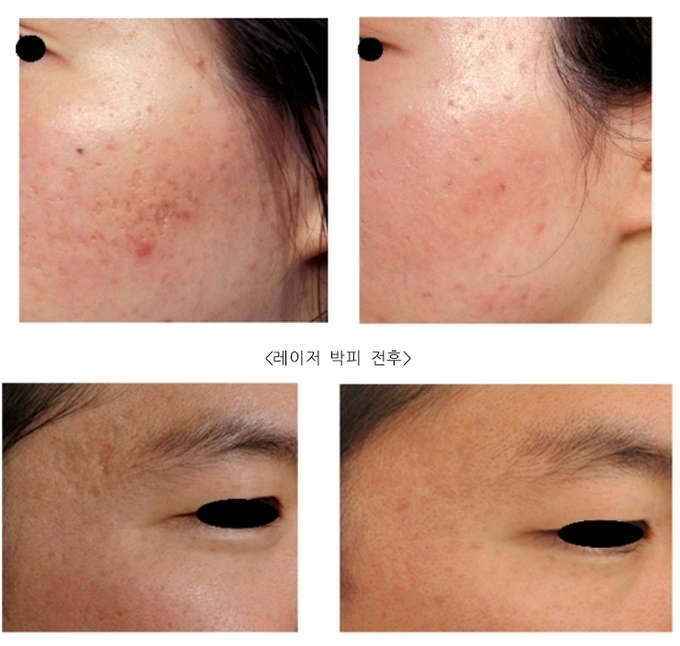 미세박피레이저 전후