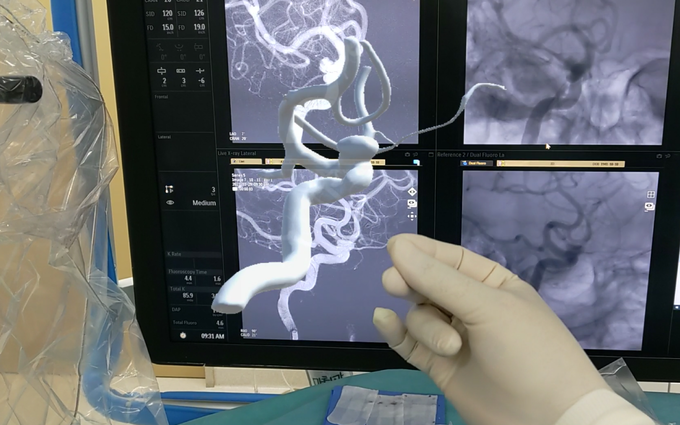윤원기 교수가 혼합현실 3D 홀로그래피 기술을 활용해 뇌동맥류 코일색전 수술을 하는 모습