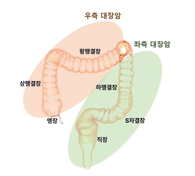 정면에서 바라본 대장암의 위치별 분류