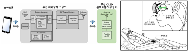 무선 OLED 콘택트렌즈를 활용한 망막전위도 검사 시스템의 모식도와 실제 검사 모습의 예시