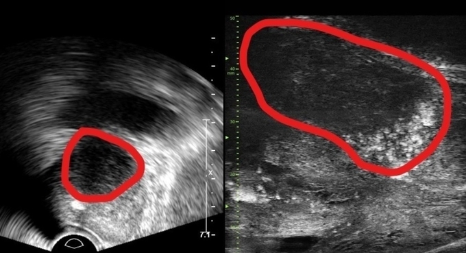 기존 전립선 초음파 사진(좌) 및 마이크로 초음파 사진(우). 기존 초음파는 전립선 부위(동그라미 친 부분)의 음영 차이로만 병변을 확인했지만, 마이크로 초음파는 높은 해상도를 통해 종양과 주변 조직의 모양까지 확인할 수 있다.
