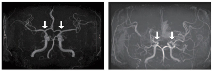 정상 및 모야모야병 환자의 뇌혈관(좌부터)