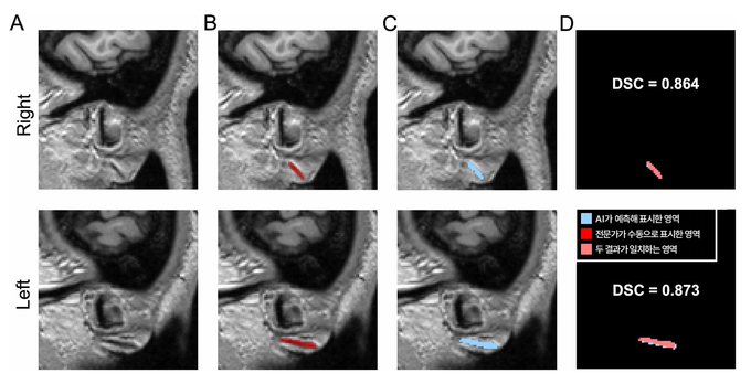 3차원 원본 이미지(A)를 토대로 전문가가 수동으로 직접 표시한 주름(B)과 AI가 예측해 자동으로 표시한 영역(C). DSC 값은 두 영역의 겹침 정도를 수치화한 것으로, AI가 전문가와 거의 일치하게(약 87%) 주름을 찾아냈다는 의미를 가진다.