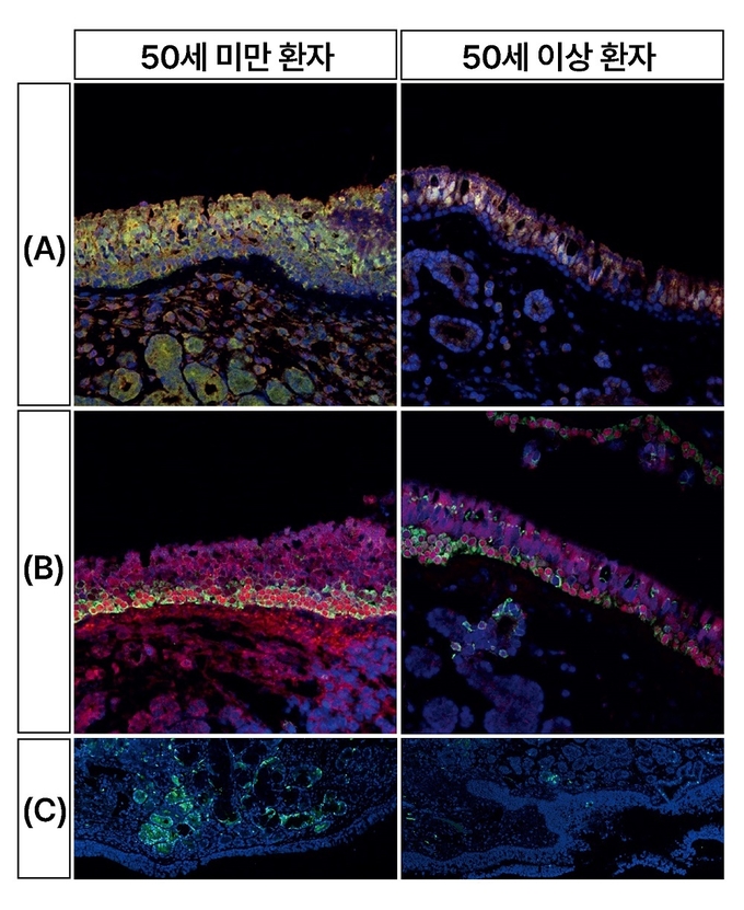 50세 미만 환자(좌)와 50세 이상 환자(우)의 세포 형광 염색 결과. 냄새를 감지하는 세포(A)와 후각 재생을 돕는 세포(B)는 형광으로 물든 면적이 넓을수록 세포 수가 많음을, S100(C)은 형광색이 강할수록 단백질의 발현 강도가 높음을 의미한다.