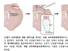 교모세포종 재발 원인 규명, 수술 후 재발 등 치료 어려운 악성 뇌종양...새 치료법 열리나