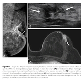 수술 전 MRI, 50세 이하 유방암 환자..."재발 예방에 효과"