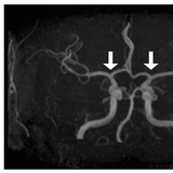 뇌로 혈액 공급하는 혈관 특별한 원인 없이 좁아지는 소아 모야모야병은, 조기 진단 길 열리나