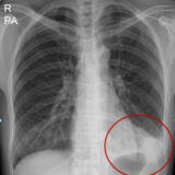 폐렴,코로나 팬데믹때 감소세하더니 이후 더 빠르게 증가..면역력 낮아진 만성 질환자, 노년층 조심해야