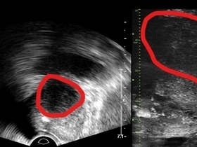 전립선암 진단 새로운 시대 열리나... 실시간 영상 통해 전립선 종양 평가,불필요한 검사와 환자 불안감 감소