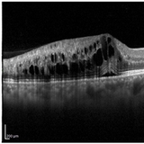 망막혈관폐쇄 환자 급증..10년 간 66 증가