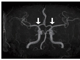 전국 소아 모야모야병 장기 역학 분석 결과...사망·뇌경색, 지속 감소 뇌출혈은 40나 줄어