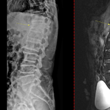 통증 없이 진행되다 골절로 드러나는 ‘침묵의 질환’ 골다공증