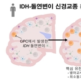 IDH-돌연변이 신경교종, 종양 덩어리 아닌 ‘겉보기 정상 뇌조직’에서 시작