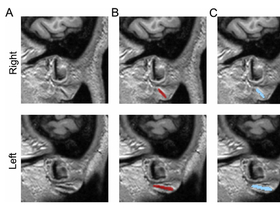 “귓불 주름이 뇌혈관 손상의 신호였다”...AI가 밝혀낸 프랭크 징후의 의학적 실체
