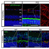 망막 변화,파킨슨병 핵심 바이오마커로 부상 하나...용인세브란스병원,조기 진단 단서 규명