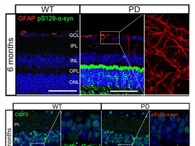망막 변화,파킨슨병 핵심 바이오마커로 부상 하나...용인세브란스병원,조기 진단 단서 규명