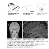 “뇌전증 환자 과소치료 심각…발작 반복에도 ‘같은 약 처방’만 ”
