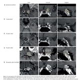 양성 수막종 치료에 “시신경 보호 위해 방사선 줄였더니…10년 뒤 종양 재발·시력 저하 위험”