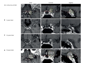 양성 수막종 치료에 “시신경 보호 위해 방사선 줄였더니…10년 뒤 종양 재발·시력 저하 위험”
