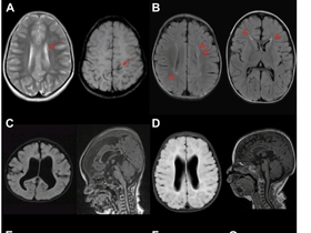 한국인 1만5천명 유전체 분석…미규명 소아 신경발달장애 원인 ‘비암호화 변이’ 규명