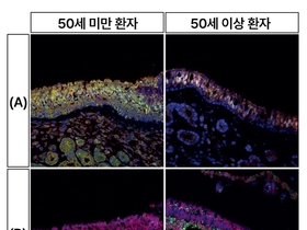 두개저내시경수술, 코에 내시경 넣어 종양 제거... 뇌조직 손상 최소화할 수 있으나 후각 저하 발생 위험