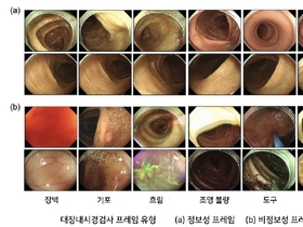 “대장내시경 AI 학습 혁신”… 서울대학교병원, 9 판독으로 16만 프레임 구축