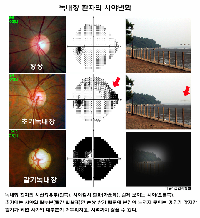 안압이 정상이어도 녹내장 증상이 나타날 수 있으므로 주의